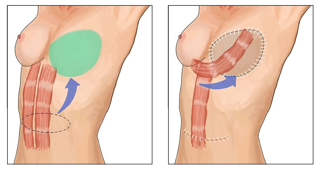 https://medtour.help/wp-content/uploads/2021/07/breast-reconstruction.jpeg