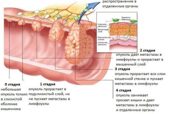 Рак кишечника 4 стадия прогноз. Аденокарцинома лечение и прогноз отзывы.