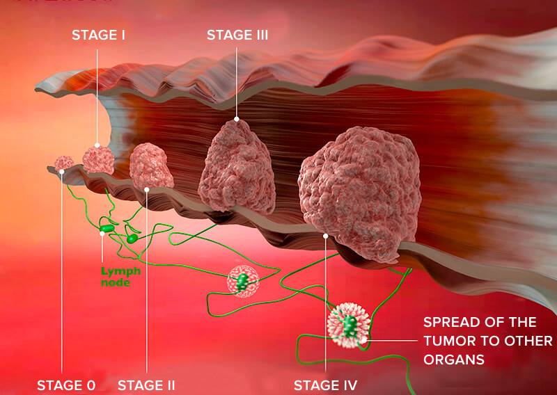 Stomach Cancer Stages