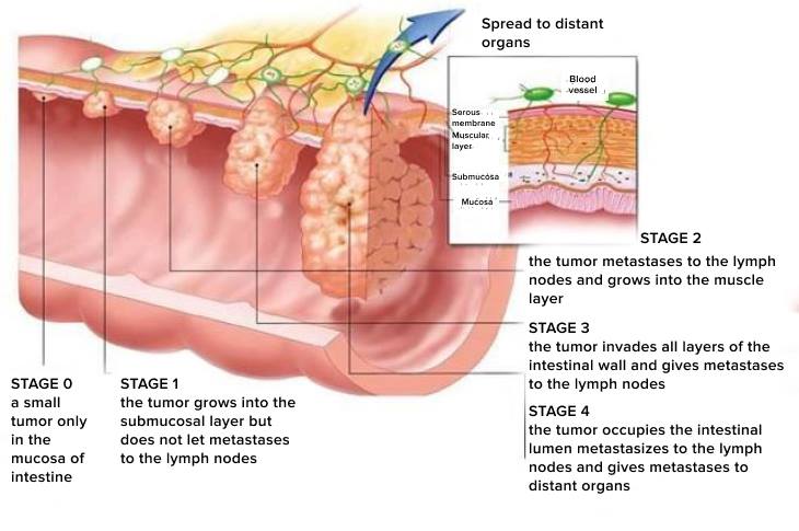 stages of cancer