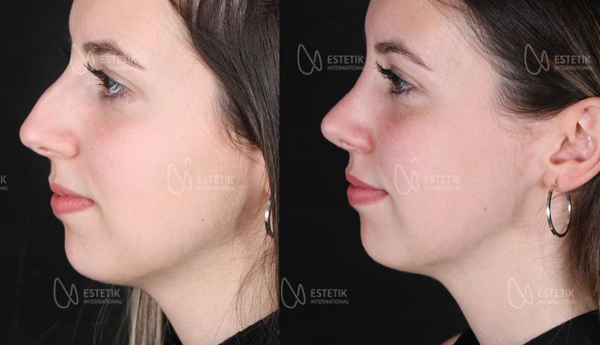 Nose plastic surgery at Estetik International