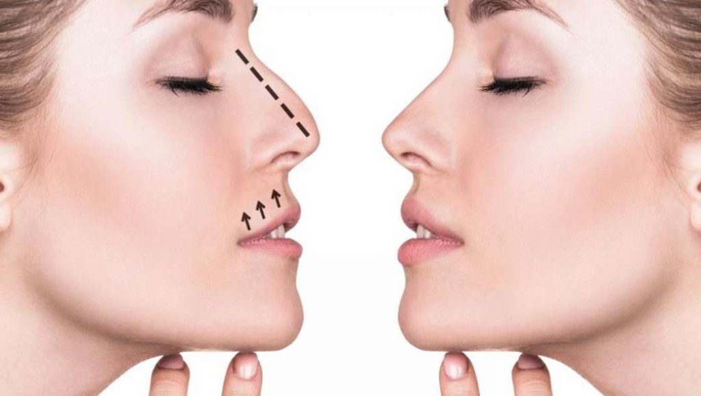 Correcting the shape of the nose