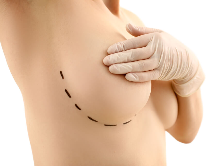 Breast reduction surgery: Women explain why they have operations