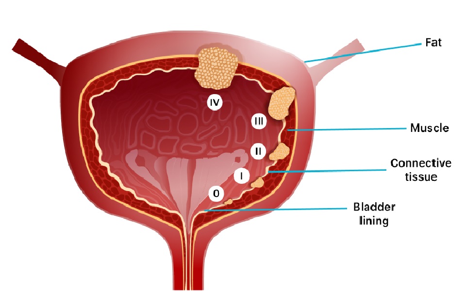 Bladder cancer stages