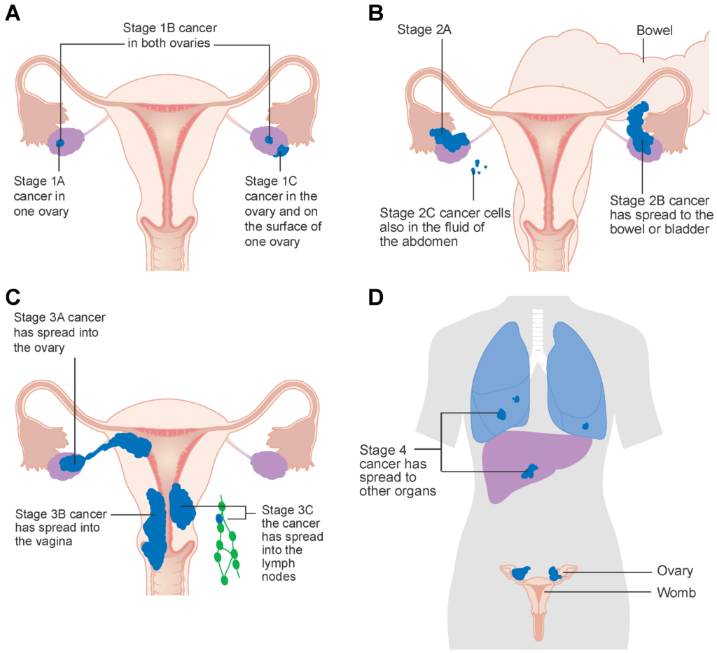 Ovarian Cancer Symptoms Diagnosis Treatment ⚕️ Medtour