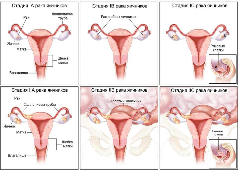 Воспаление яичников: лечение хронического, двустороннего, правого, левого яичника у женщин