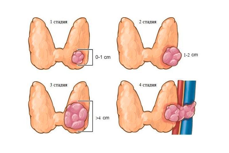 4 стадии рака щитовидной железы