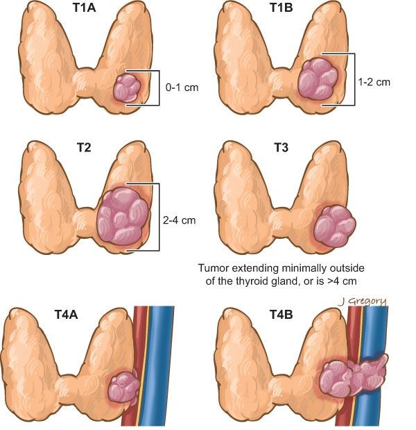 Stages of thyroid cancer