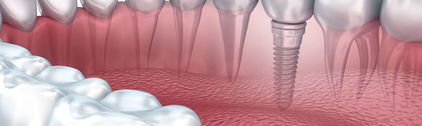 Стратегические (базальные) зубные импланты