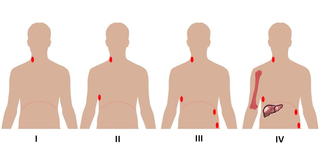 lymphoma stage