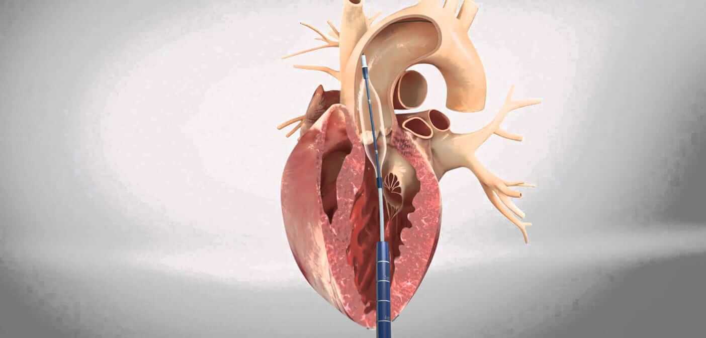 Операция по замене сердечного клапана ⚕️ MedTour