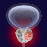 Prostate cancer prevention and early diagnostics