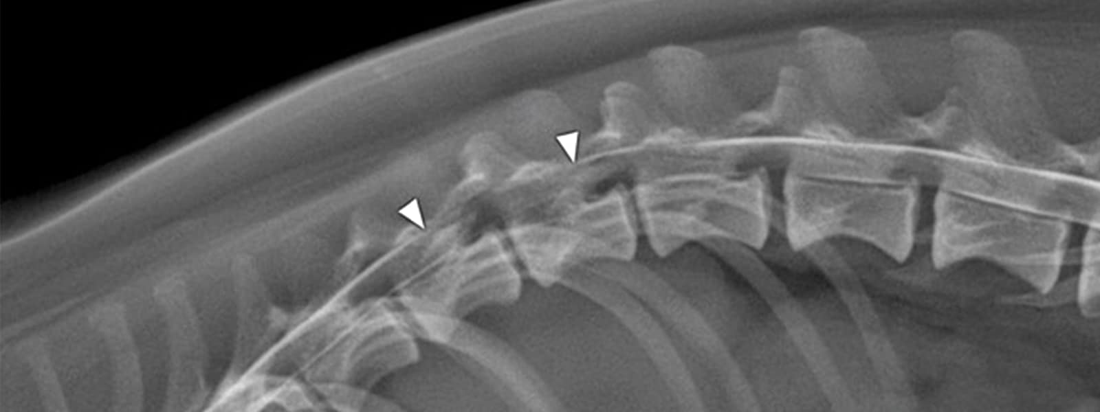 herniated disc