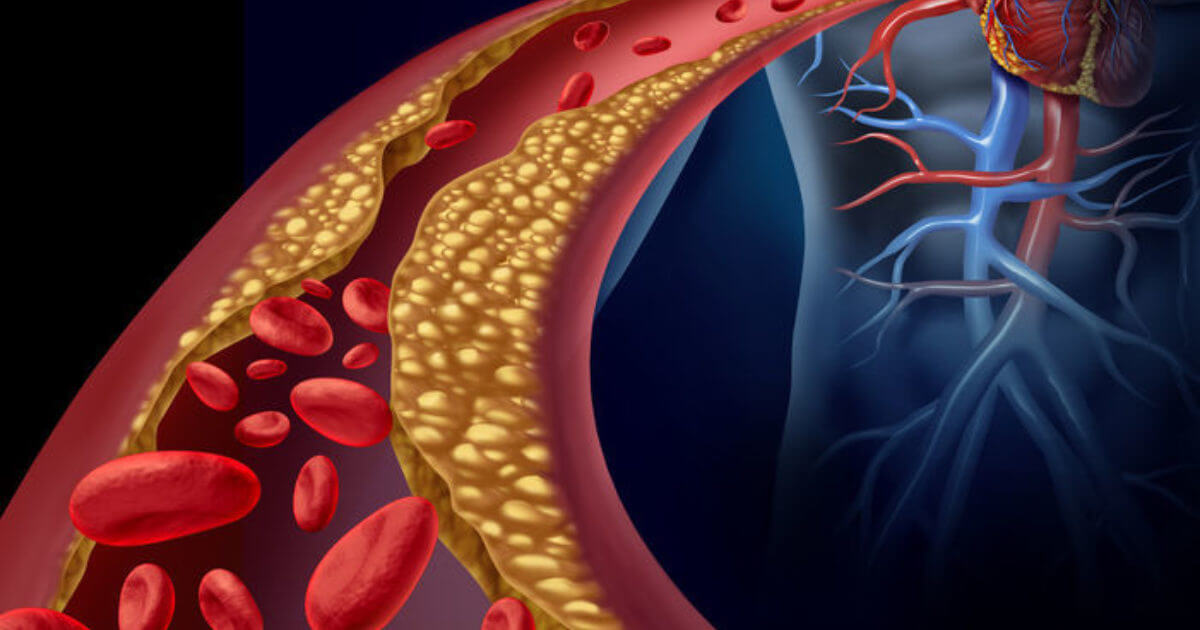 Атеросклероз брахиоцефальных артерий — причины появления и лечение
