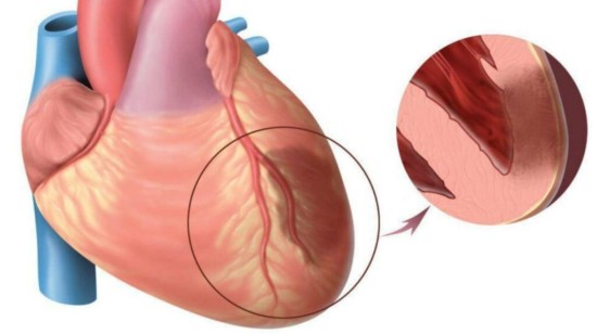 Инфаркт миокарда: симптомы, диагностика и эффективные методы лечения
