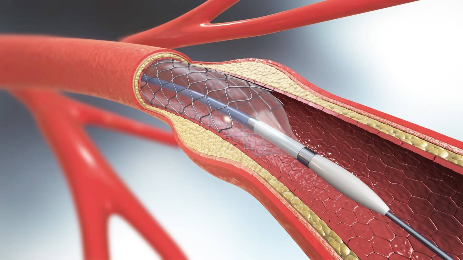 Heart stenting