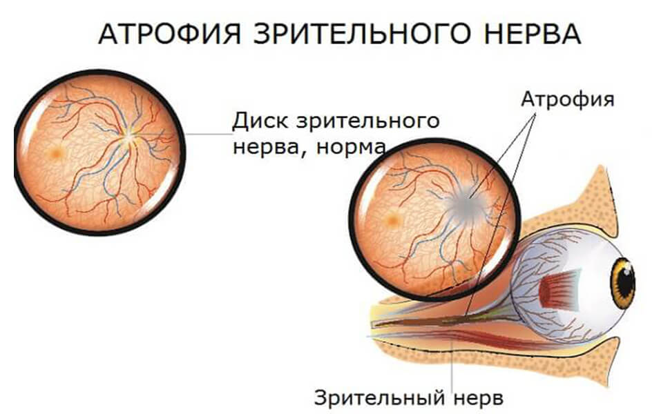 Причины и патогенез атрофии зрительного нерва