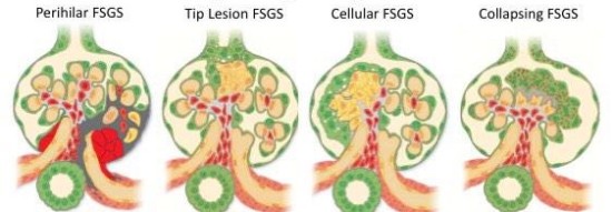 Focal Segmental Glomerulosclerosis - MedTour