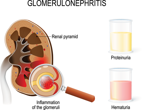 Glomerulonephritis