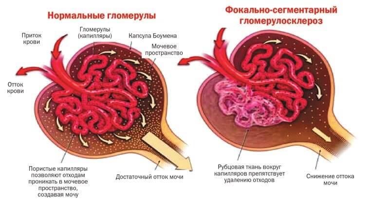 Гломерулосклероз