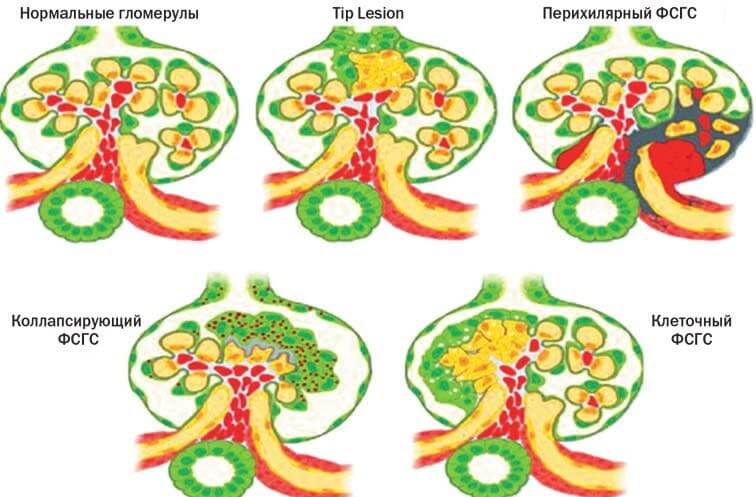 Гломерулосклероз лечение