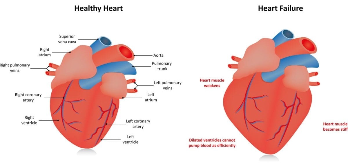 heart failure