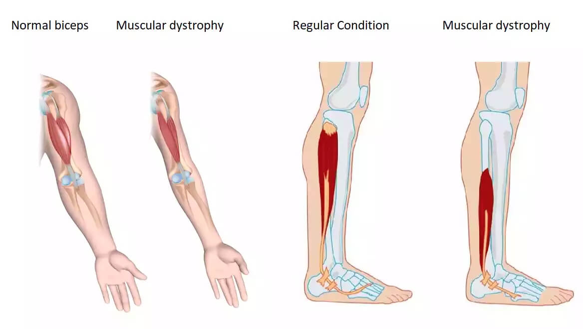 Дистрофия мышц ног: причины, симптомы, способы лечения