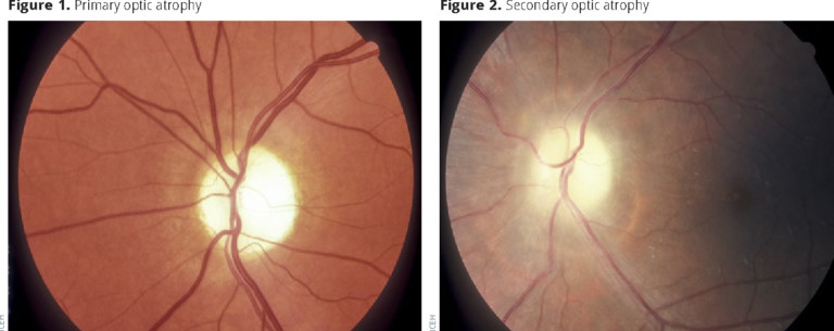 optic-nerve-atrophy-medtour