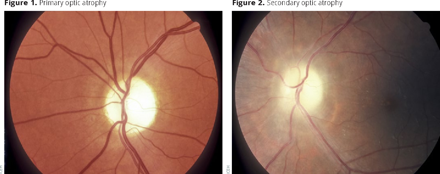 Optic nerve atrophy types
