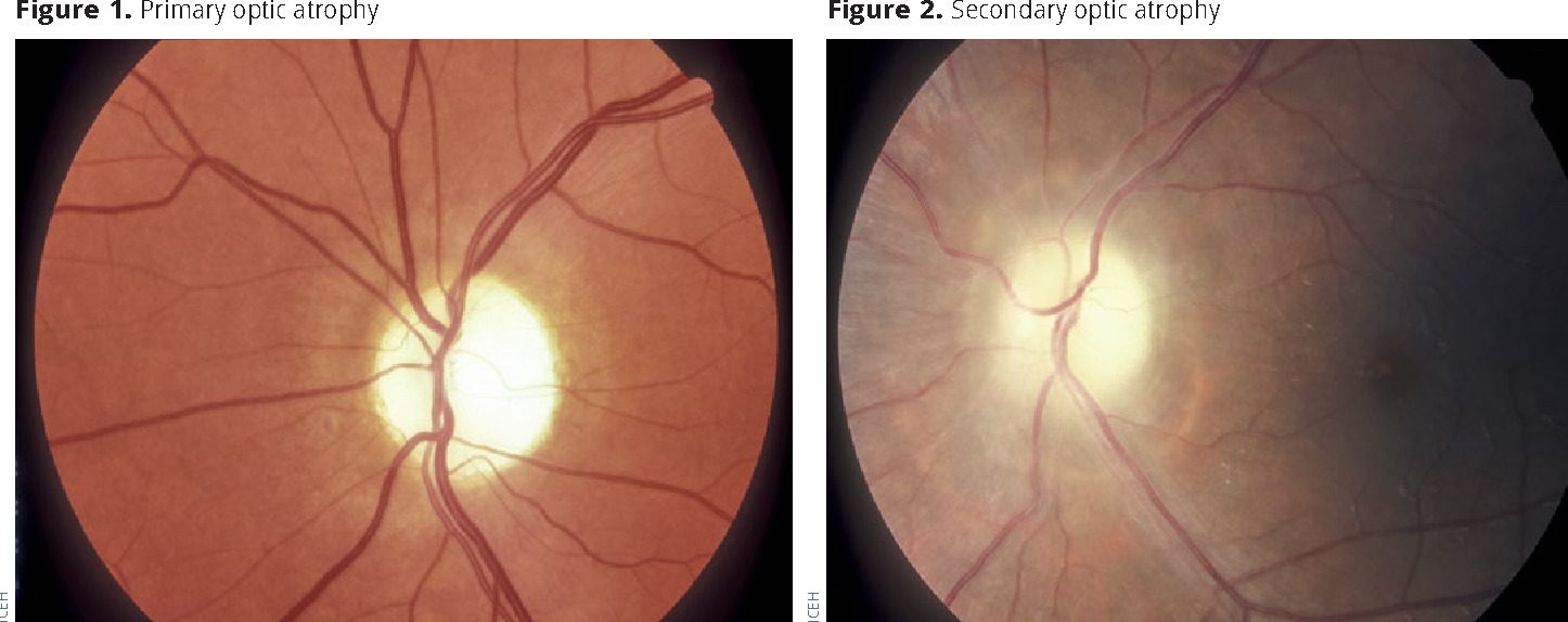 Optic Nerve Atrophy MedTour