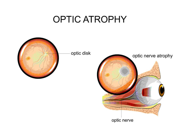 Optic nerve atrophy