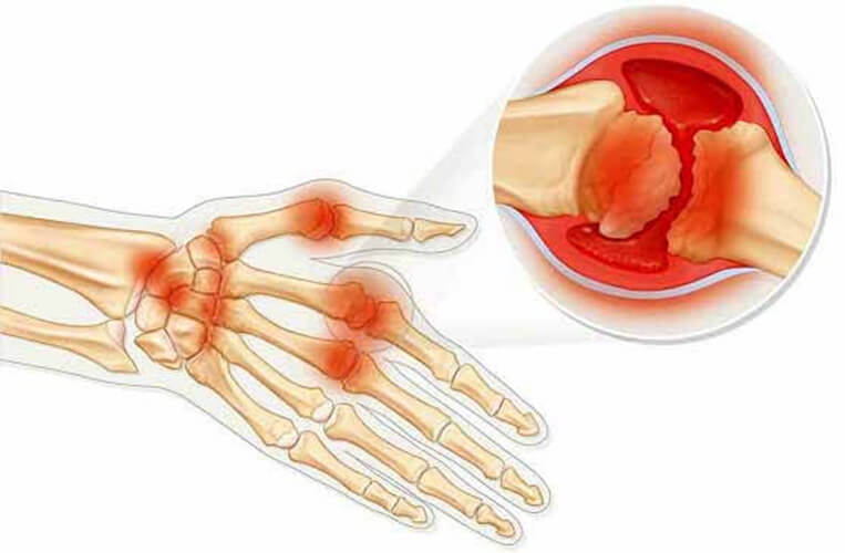 Что такое ревматоидный артрит артрит? Симптомы ревматоидного артрита и лечение суставов