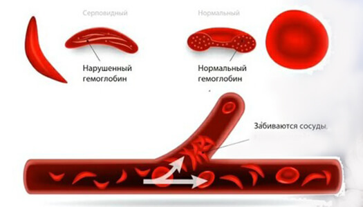 Серповидноклеточная анемия причины