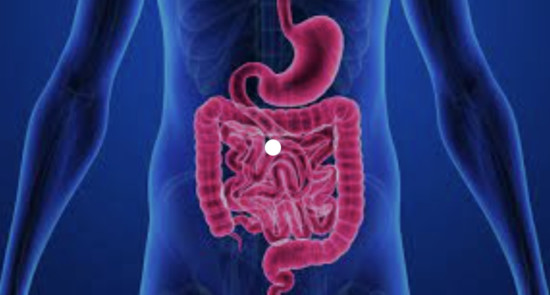 Crohn's disease_3