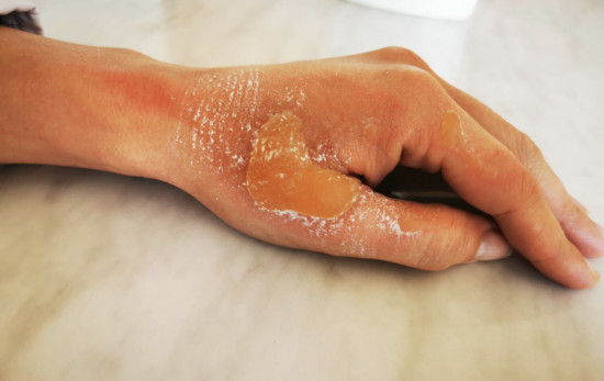 Ожоги кожи: правила первой помощи и лечения: статьи клиники Оксфорд Медикал Киев