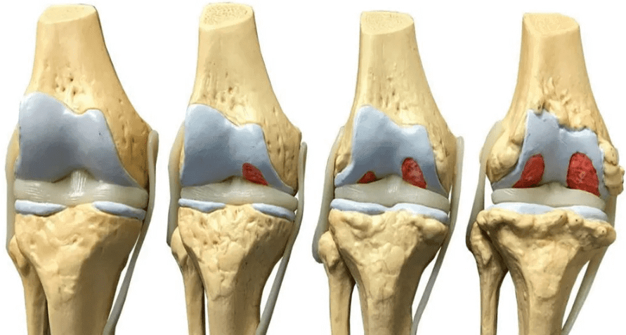 osteoarthritis stages 