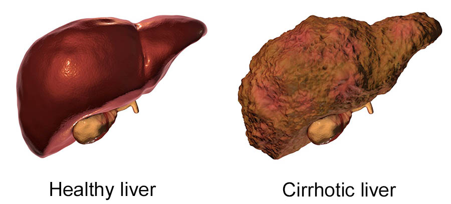 Stages of cirrhosis