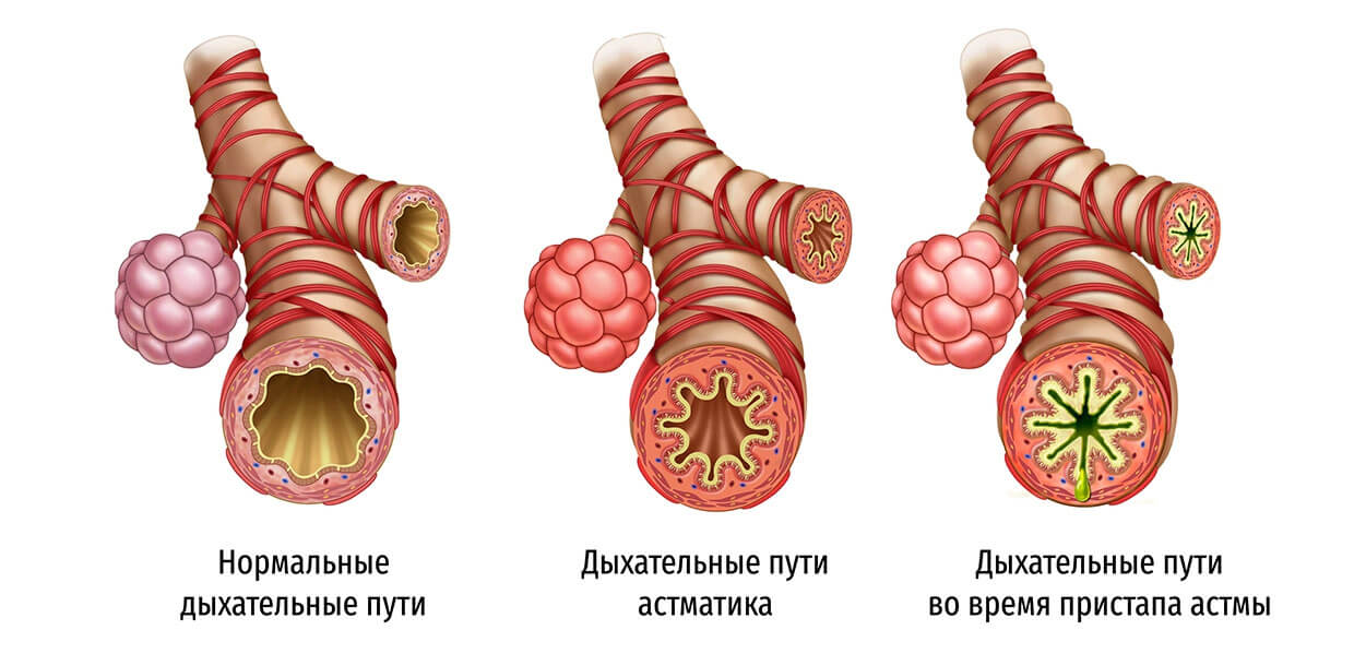 Бронхиальная астма: причины, симптомы, диагностика и лечение ǀ Клиника «СОВА» Воронеж