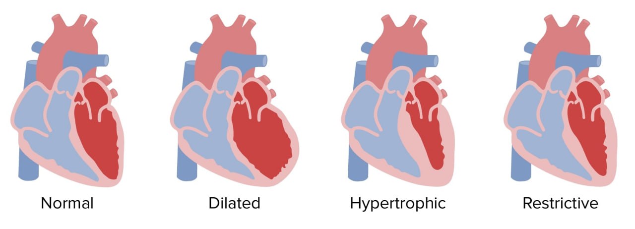 Cardiomyopathy