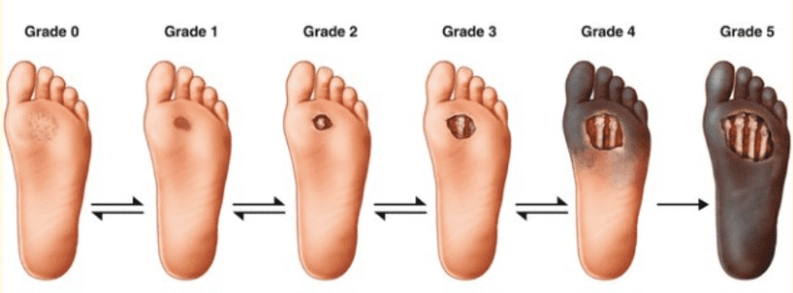 Diabetic foot stages