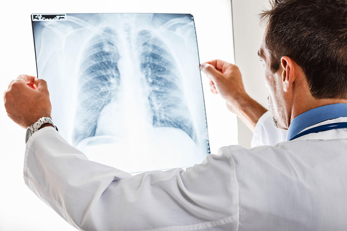 Diagnosis of pulmonary fibrosis