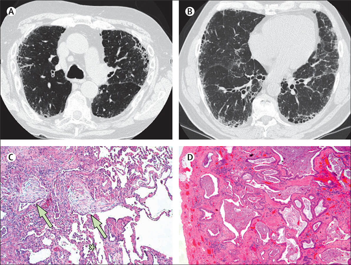 Symptoms of pulmonary fibrosis