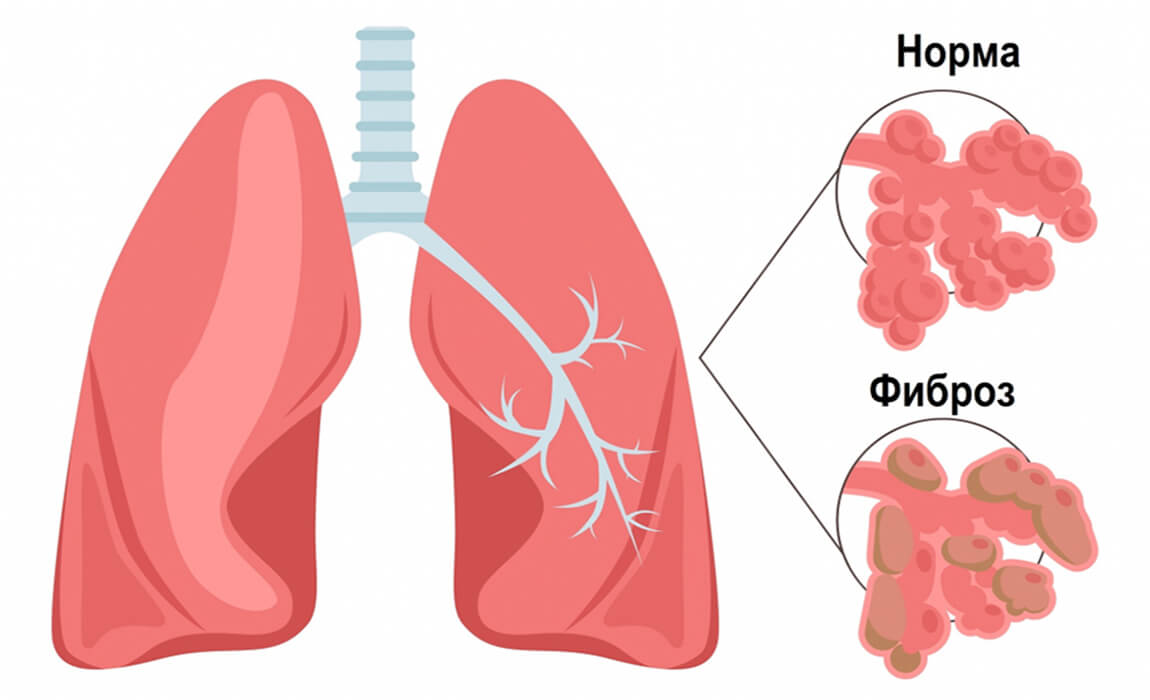 Causes of pulmonary fibrosis