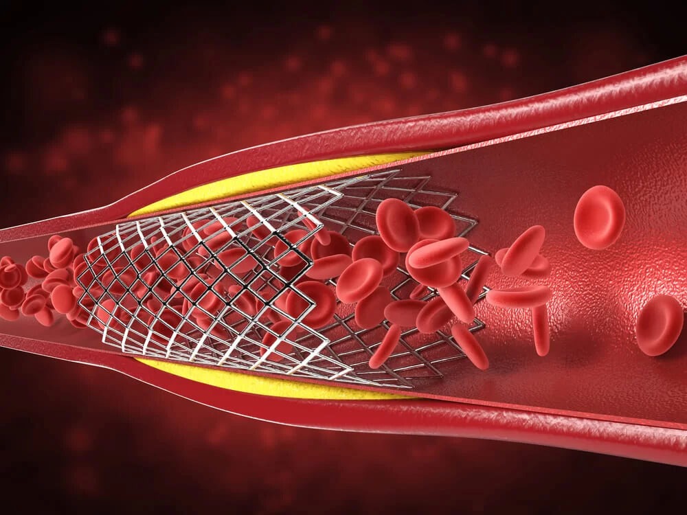 Симптомы облитерирующего атеросклероза артерий нижних конечностей
