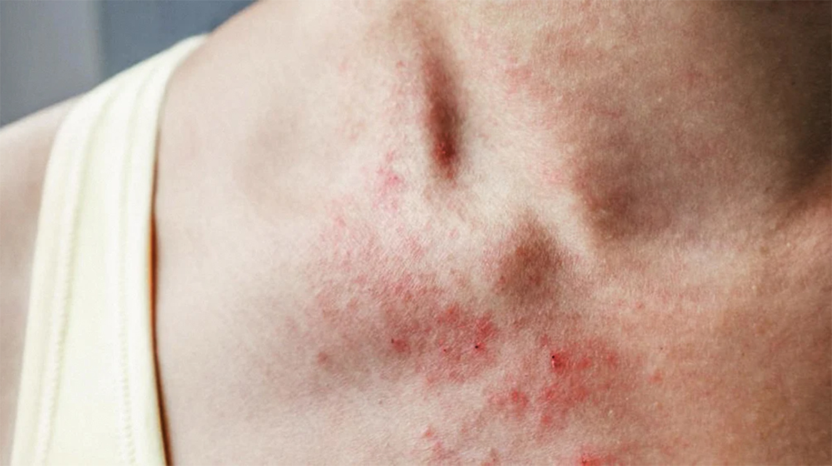 Allergic reaction heat rash  What causes it and how is it treated? -  us.klarify