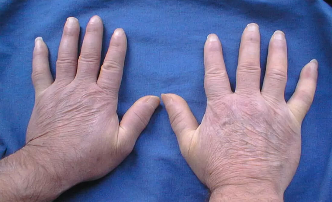 Stages of scleroderma
