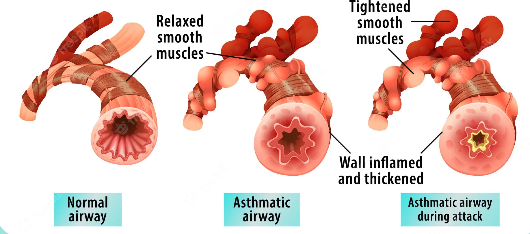 Symptoms and signs of bronchial asthma