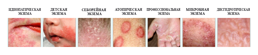 Types of eczema