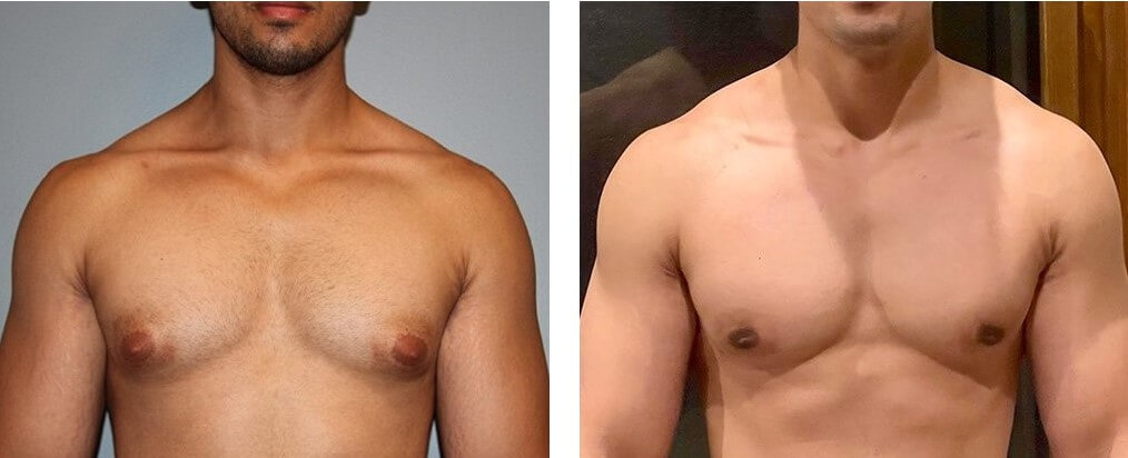 Gynecomastia – symptoms, causes, diagnosis, and treatment in the best  clinics MedTour