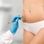 Liposuction: what do you need to know